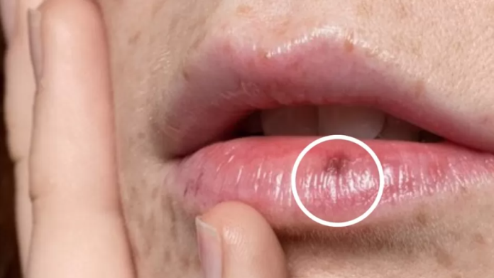 ¿Manchas en los labios? Por qué salen y cómo quitar