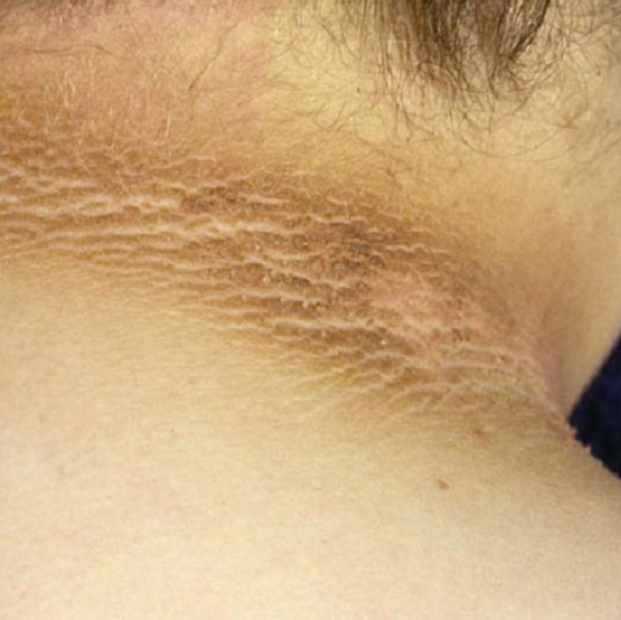 La Señal de Alerta Más Clara: Acantosis Nigricans