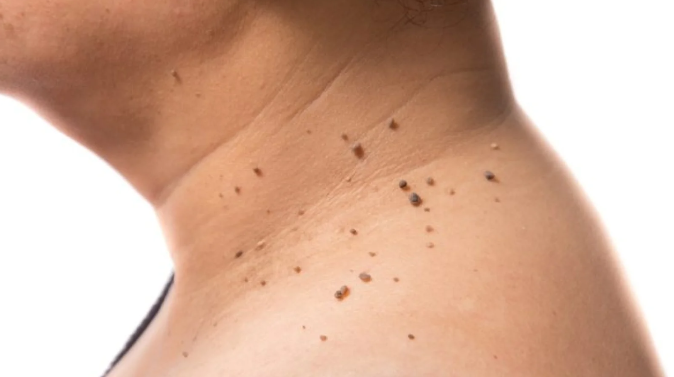 Los Pequeños Colgantes: Acrocordones