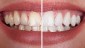 Mujer frotando la parte blanca de una cáscara de naranja sobre sus dientes para blanquearlos de forma natural.