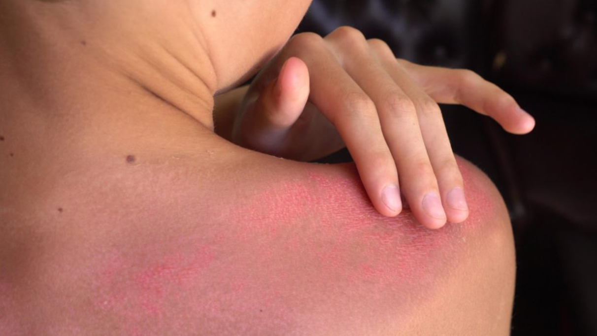 Primeros pasos ante una quemadura solar severa